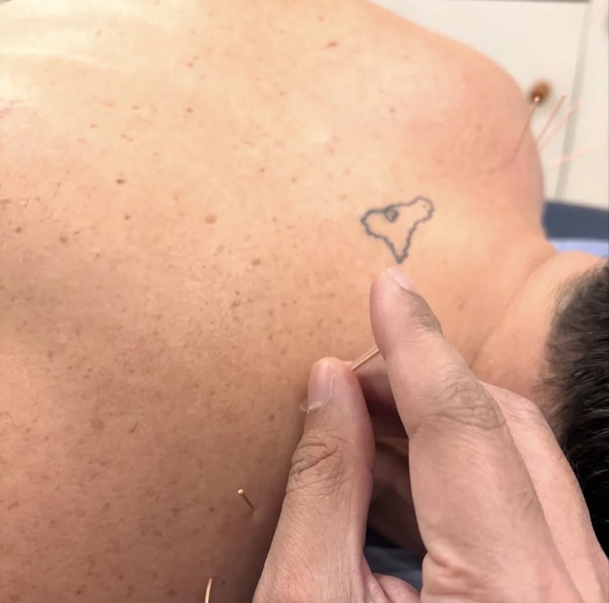 Medical Acupuncture